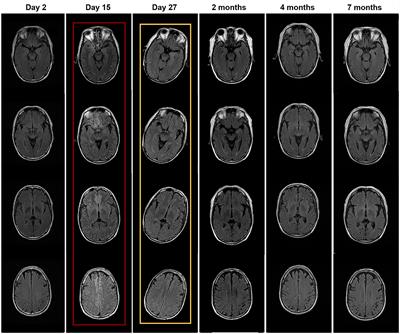 Case report: Anti-neurexin-3α-associated autoimmune encephalitis secondary to contrast-induced encephalopathy